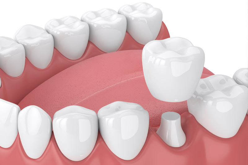 Dental Crowns in Honolulu